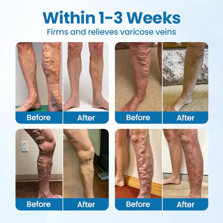 HEALRIZE® VeinGuard Herbal Spray-✅ Clinically proven to eliminate varicose veins in just 7 days!