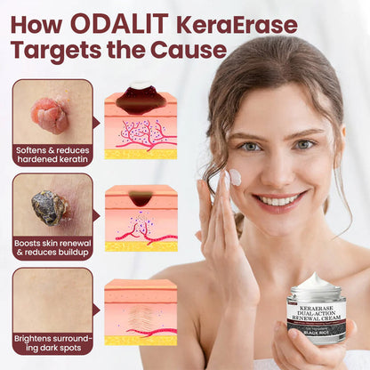 ✅Flash Sale - HEALRIZE® KeraErase Dual-Action Renewal Cream